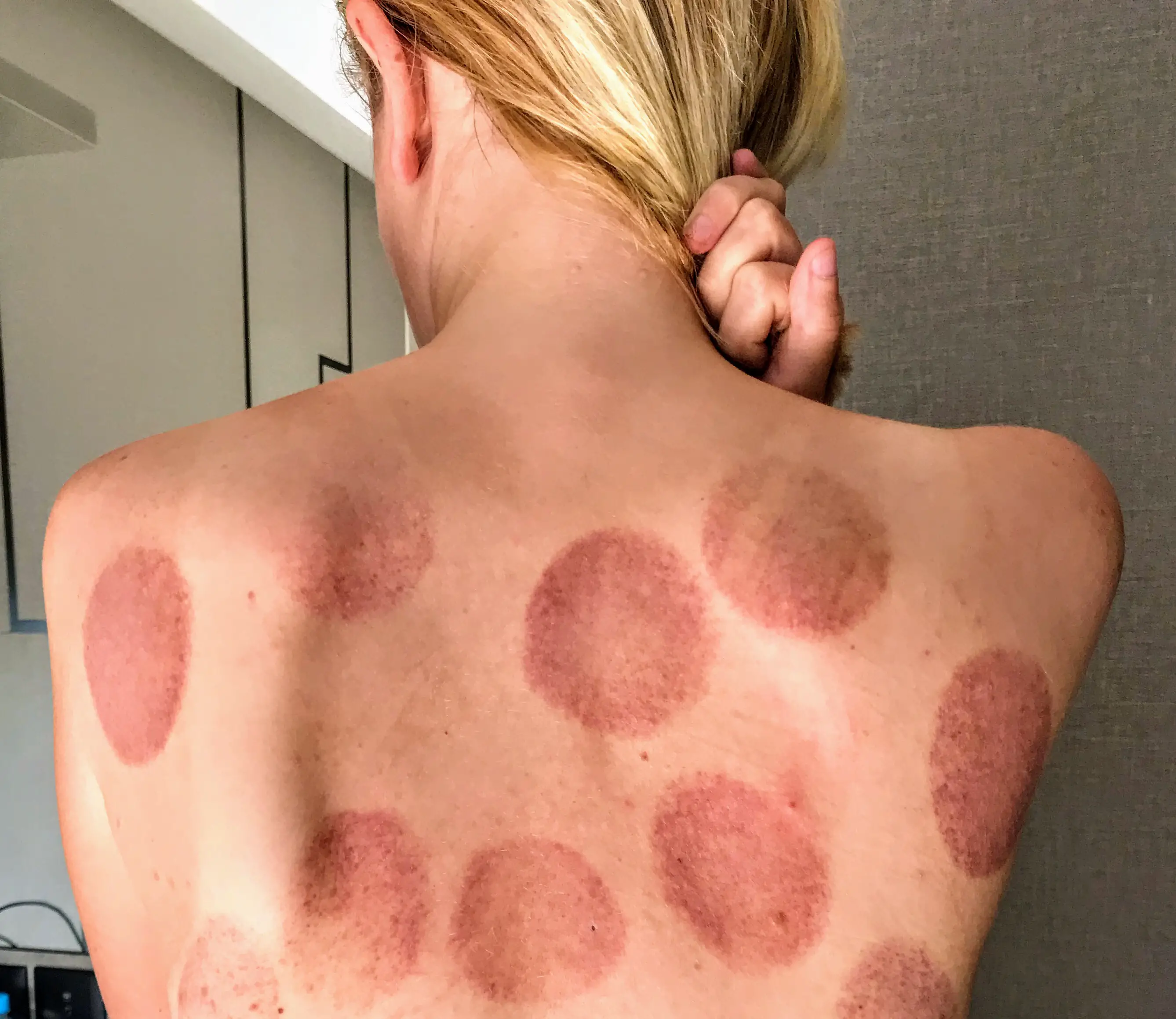 Cupping marks on my back, Melaka, Malaysia
