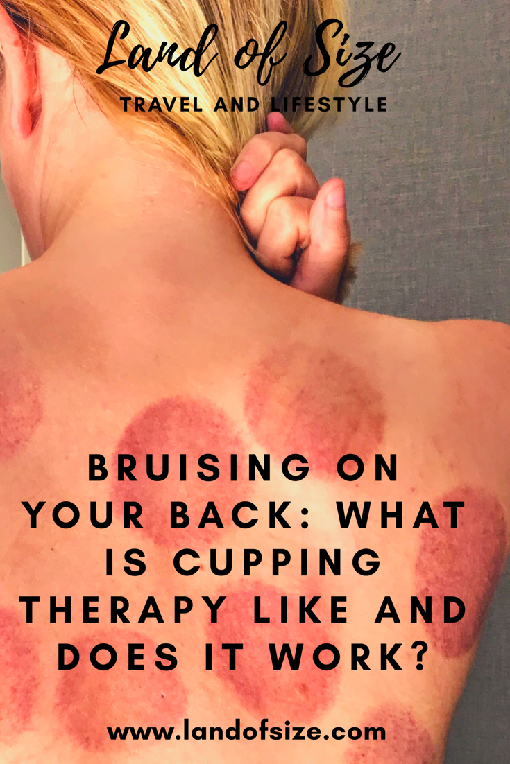 Bruising on your back: What is cupping therapy like and does it work?